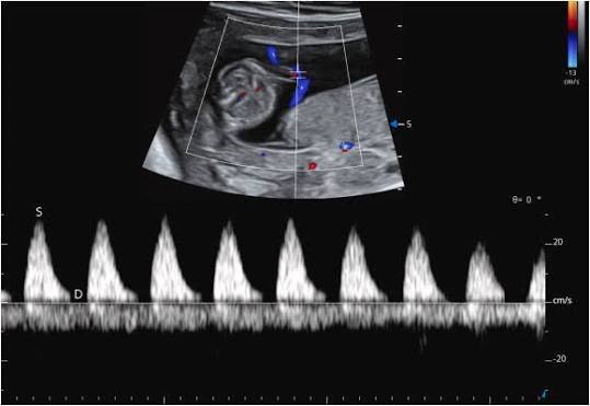 Fetal Doppler Studies